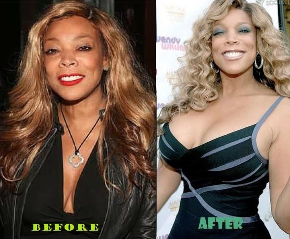 A picture of Wendy Williams before and after breast implants.